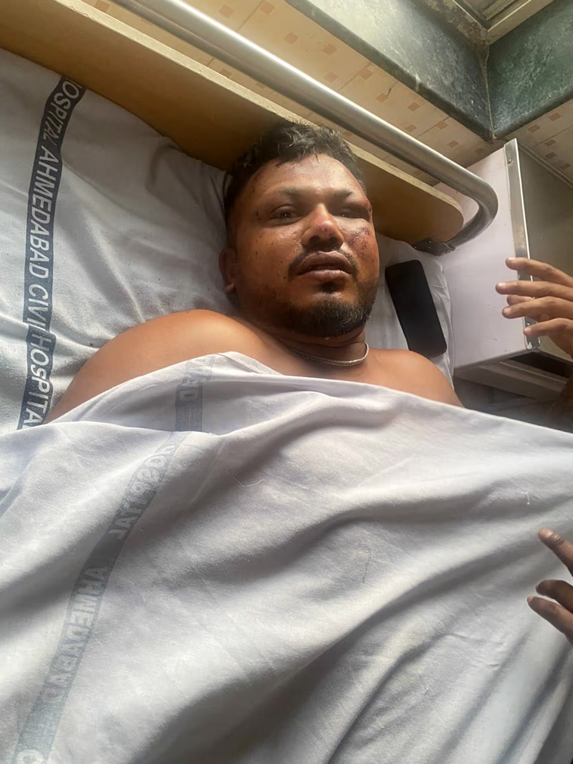 Injured survivor of Air India flight AI171 crash in hospital bed.